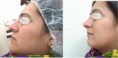 /album/fotogaleria-bioplastia-nasal-no-quirurgica/antesdp-jpg1/